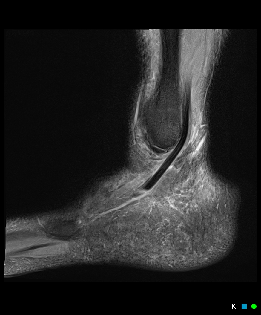 Figure 4 for case SPR tear proximal to fibular insertion